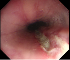 Treatment 2 esophagitis grade B