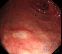 FIII duod ulc e1729553248538