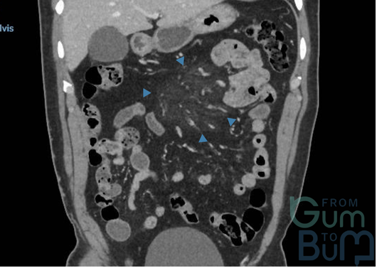 mesenteric panniculitis