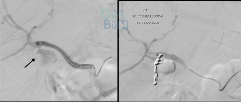 Gangrenous cholecystitis- causing a pseudoaneurysm arising from the cystic artery. 
Coil embolisation with micro tornado coils with isolation
of the pseudoaneurysm.